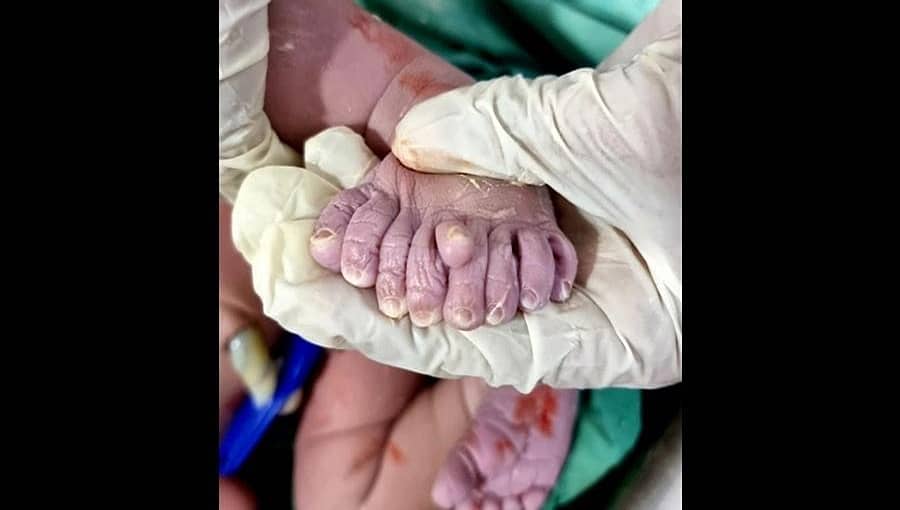 ಹೊಸಪೇಟೆ: ಒಂದೇ ಪಾದದಲ್ಲಿ ಒಂಬತ್ತು ಕಾಲು ಬೆರಳೊಂದಿಗೆ ಜನಿಸಿದ ಮಗು, 'ದೇವರ ವರ' ಎಂದ ಕುಟುಂಬ!