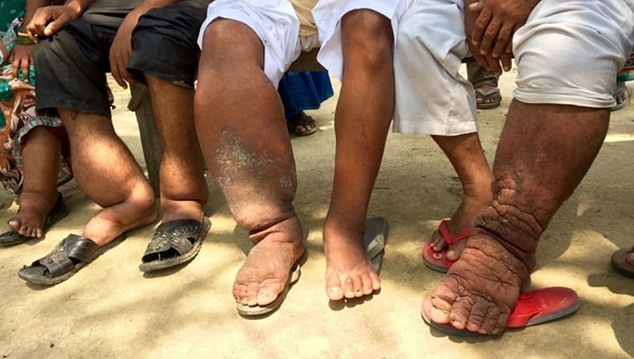 ಆನೆಕಾಲು ರೋಗ (ಕುಶಲವೇ ಕ್ಷೇಮವೇ)